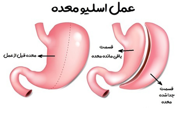 عمل اسیلو یا گاسترکتومی