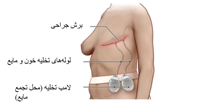 ماستکتومی