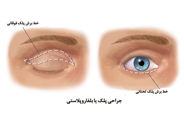 جراحی پلک