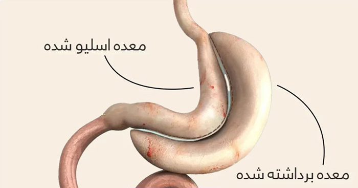 جراحی اسلیو معده