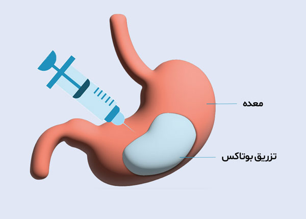 درمان بوتاکس برای معده چگونه انجام می شود؟