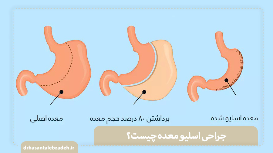 جراحی اسلیو معده