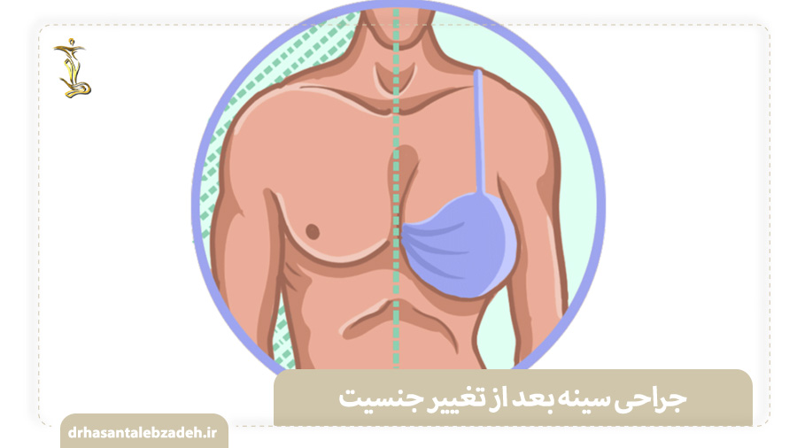 جراحی سینه و تغییر جنسیت